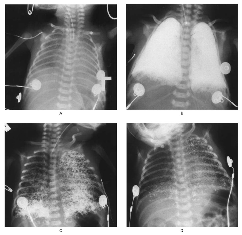 一名婴儿在进行气体通气治疗期间（图A），在使用全氟溴烷进行部分液体通气后1小时（图B）以及在最后一次给药后48小时（图C）和3周（图D）的胸部X线照片。